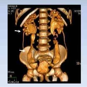 компьютерная томография при мегауретере