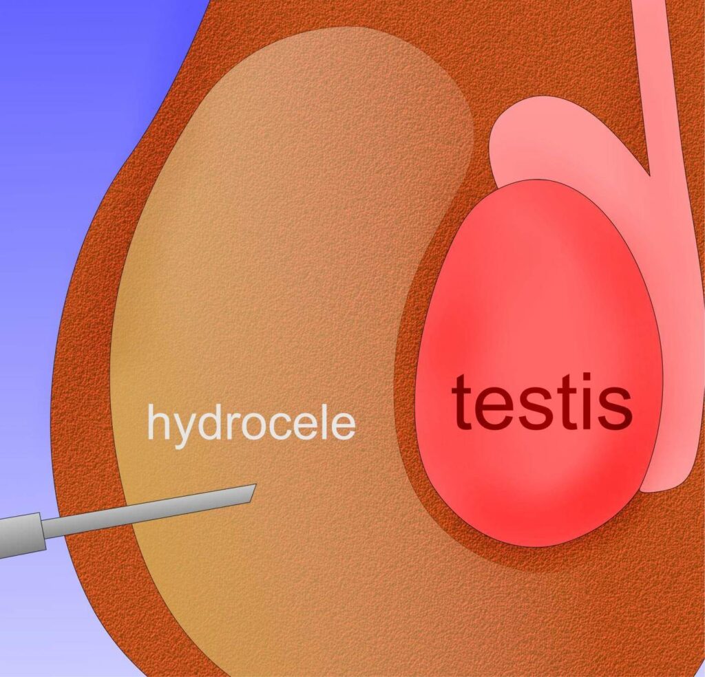 Пункция яичковой полости при гидроцеле  у детей
