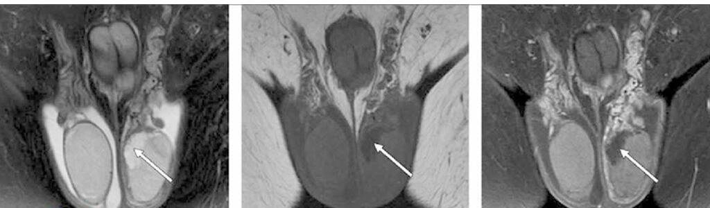 Опухоль яичка по данным томографии